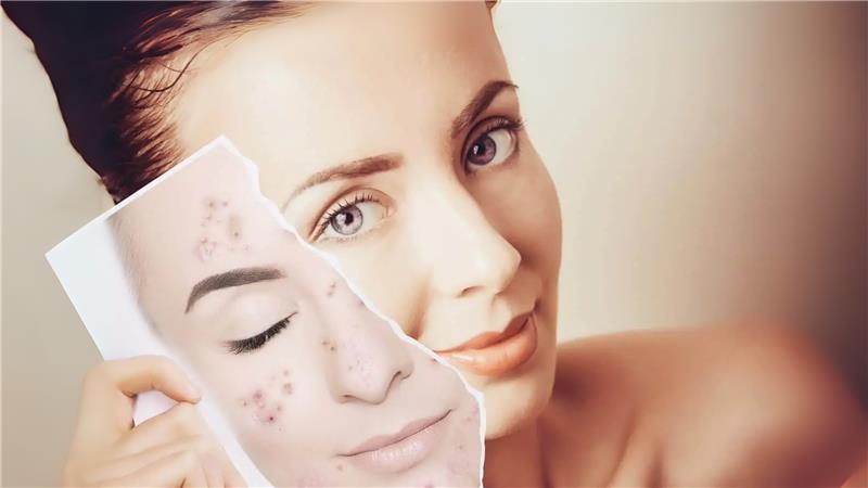 Acne-Prone Skin Clearer