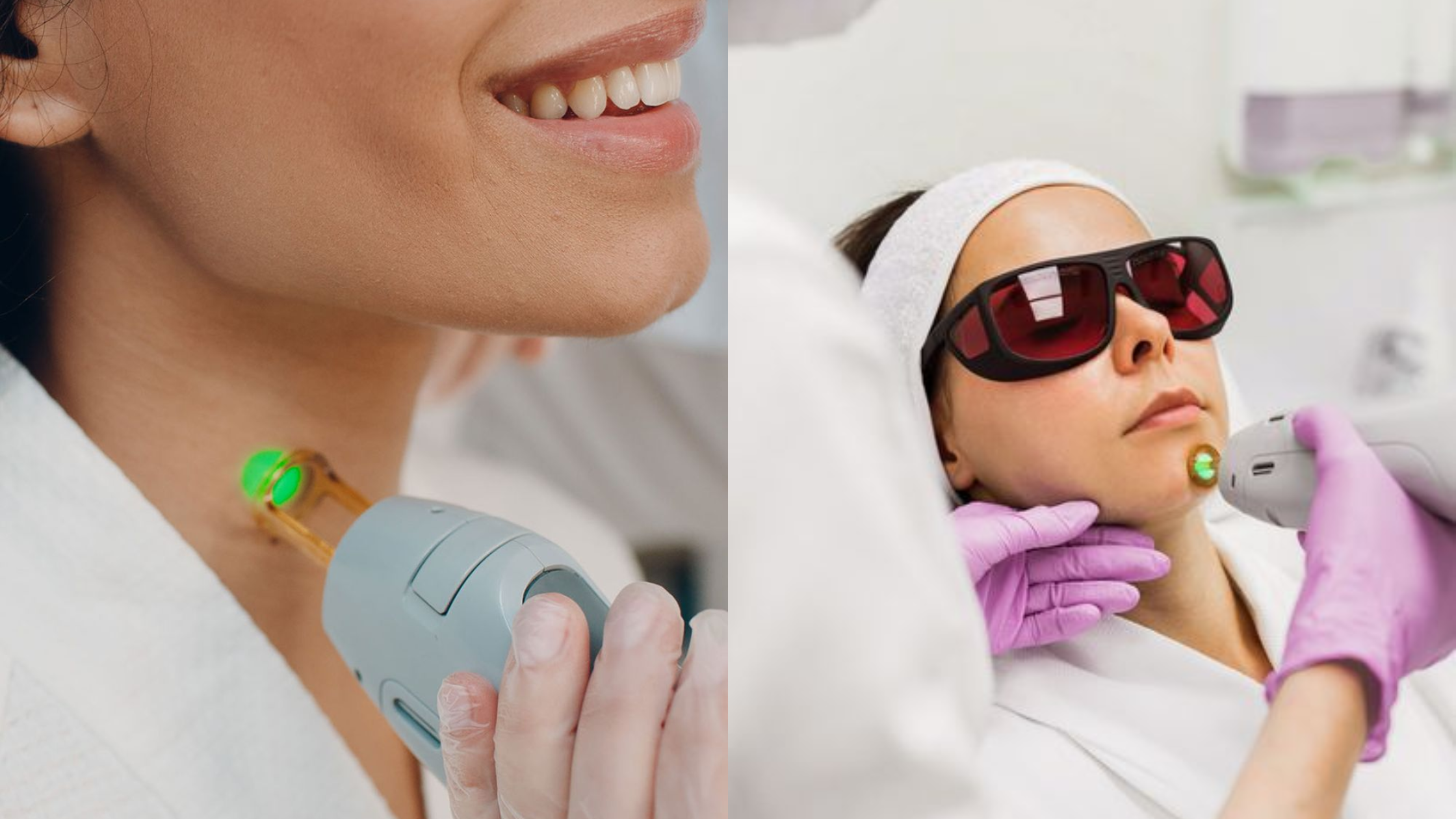 Chin & Neckline Laser Treatment