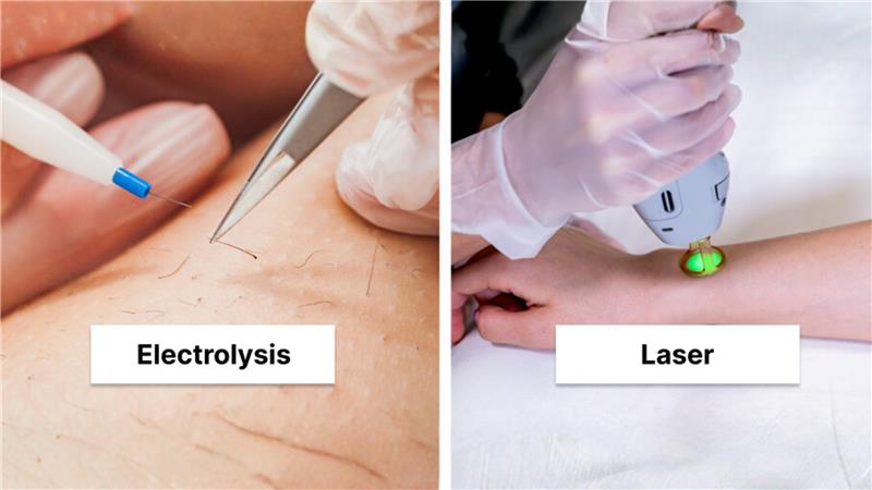 electrolysis vs laser hair removal
